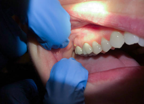 Best Emergency Tooth Extraction in Ball Ground, GA