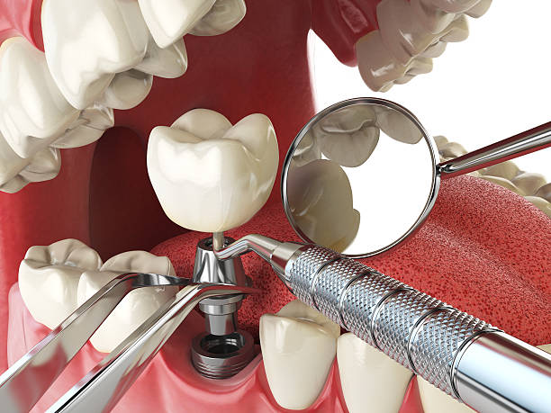 Best Emergency Dental Care for Broken or Chipped Teeth in Ball Ground, GA